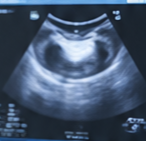 Ultrasound scan process